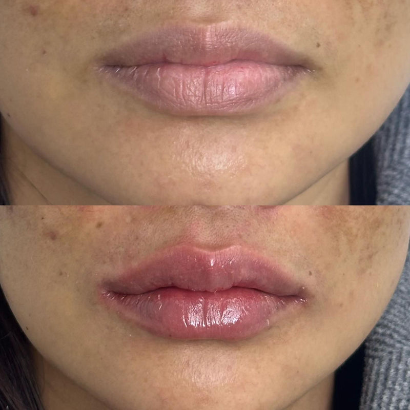 Korean/ Asian Lips Filler