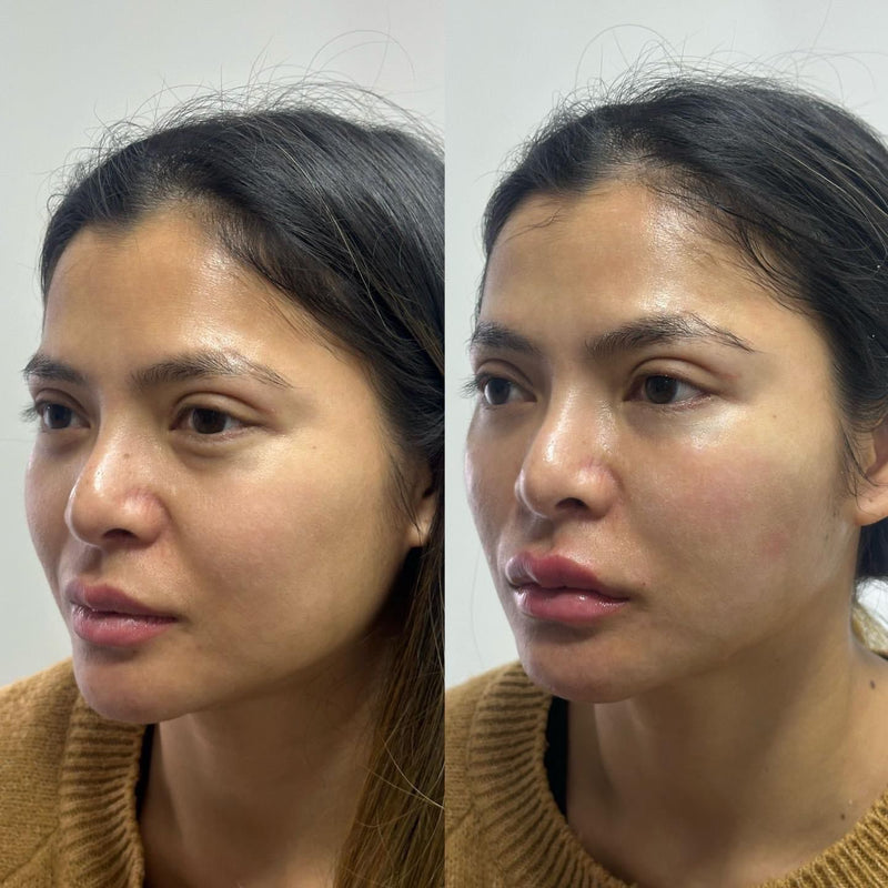 Korean/ Asian Lips Filler