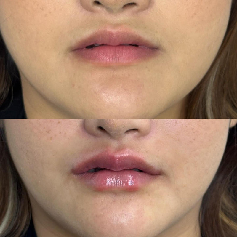 Korean/ Asian Lips Filler