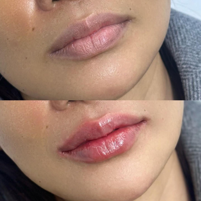 Korean/ Asian Lips Filler