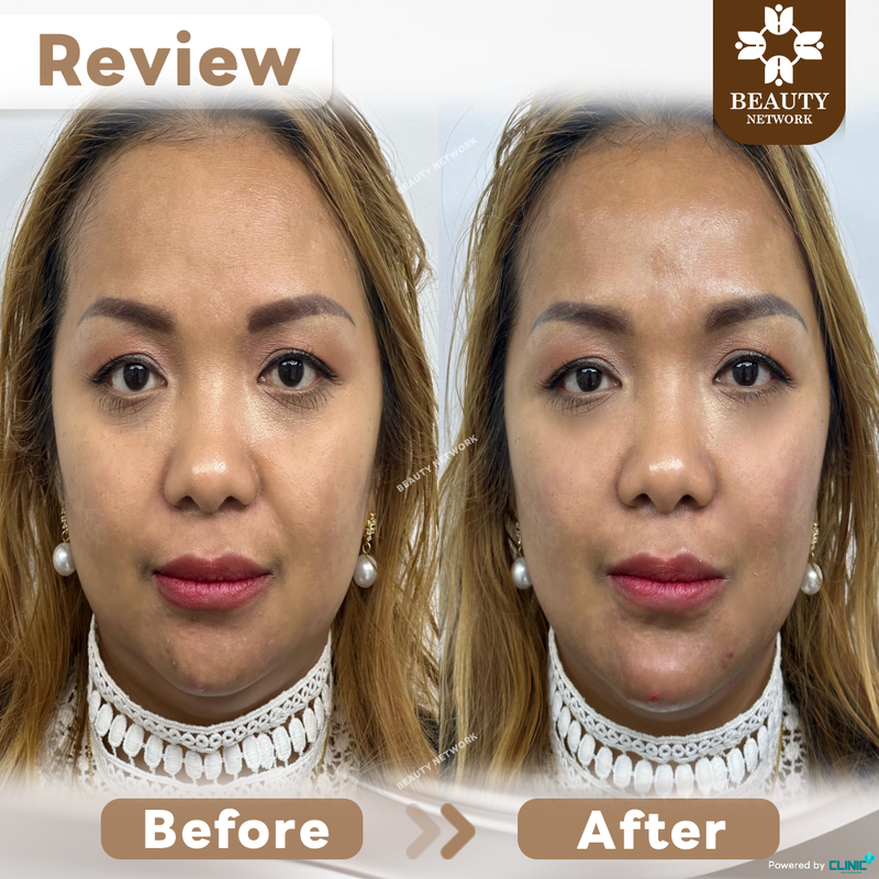 Natural Chin Filler