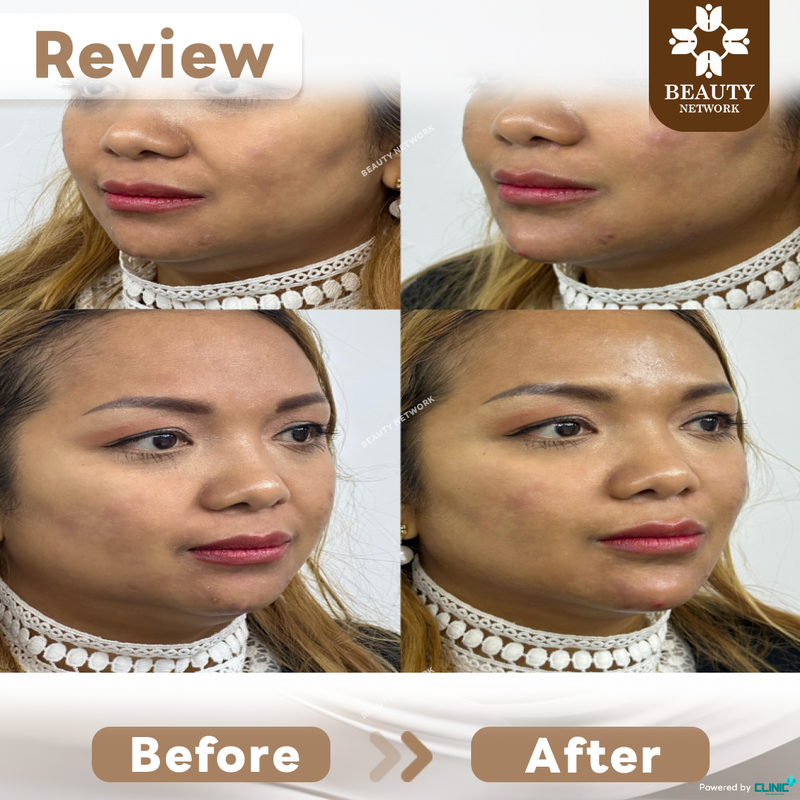 Natural Chin Filler